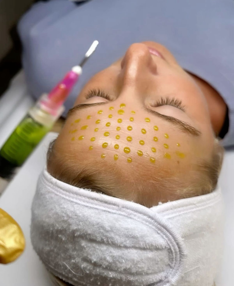 BioRePeel Chemical Peel