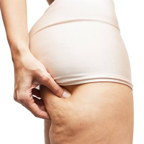 Cellulite Treatment- 4 Sessions