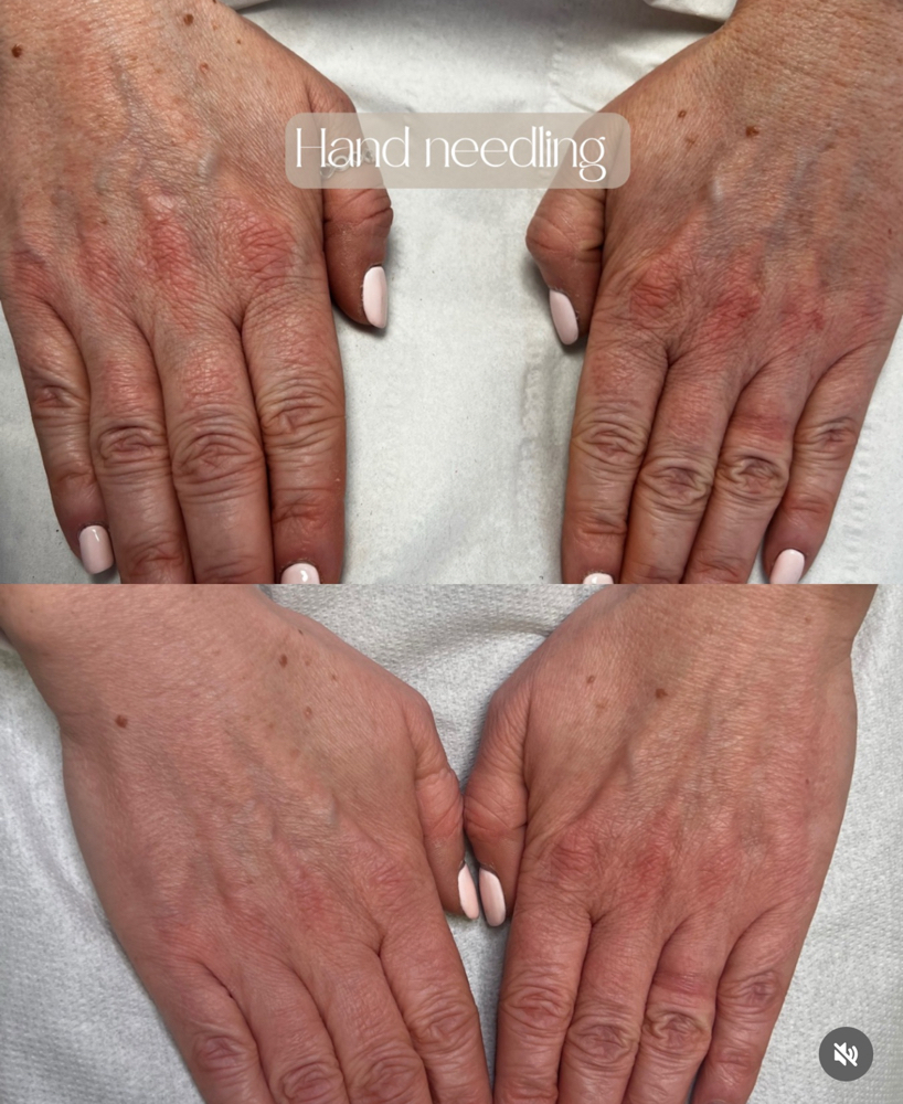 Hand Micro-needling
