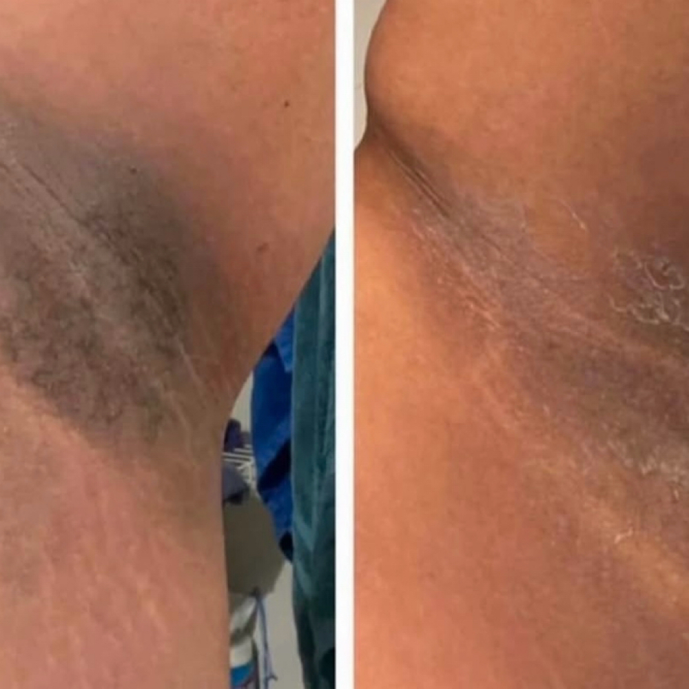 Bleaching at Oshun X Venus CosmoSpa in Valdosta, GA