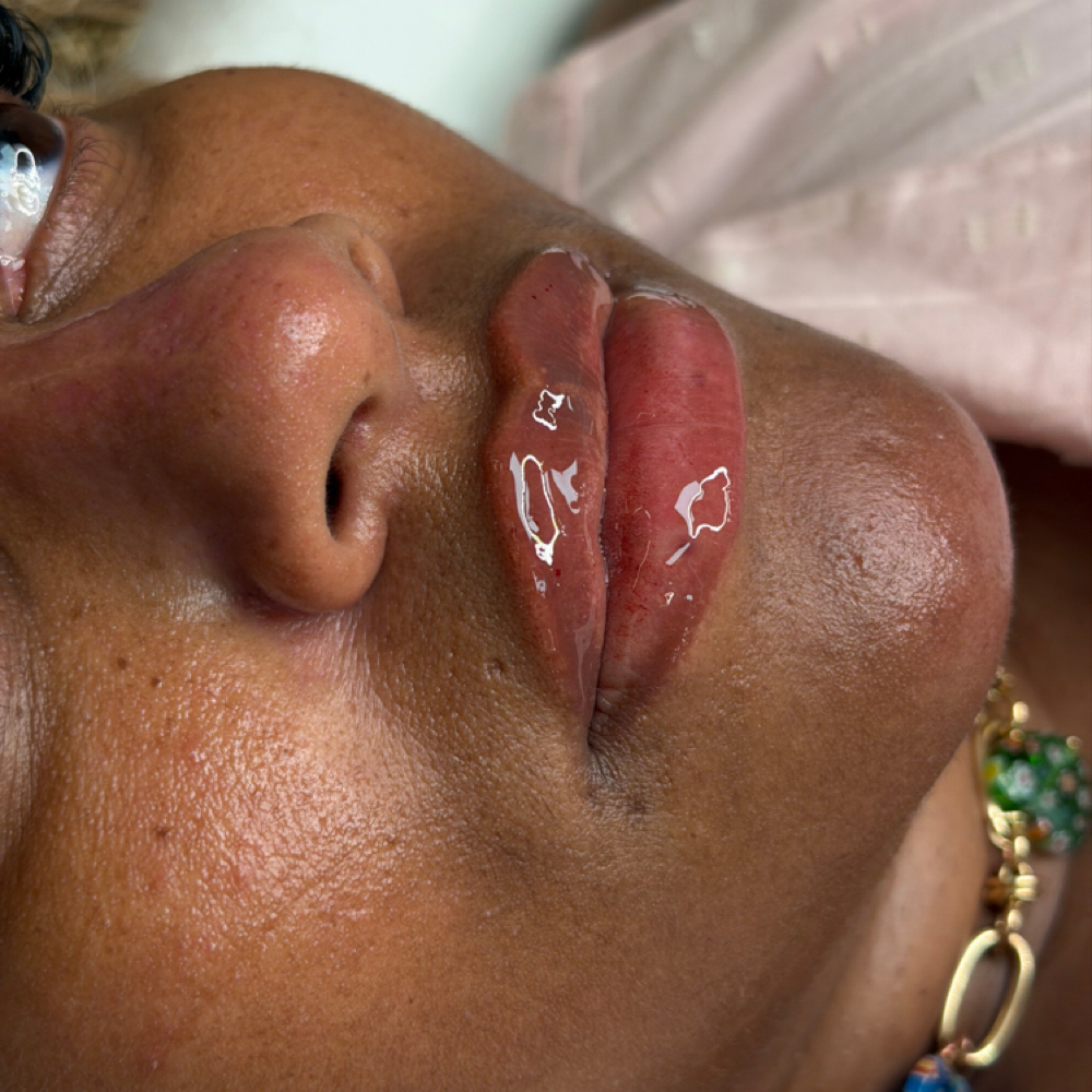 0.5 ML Mirconeedle Lip Filler at Karisma Beaute Effect in Atlanta, GA