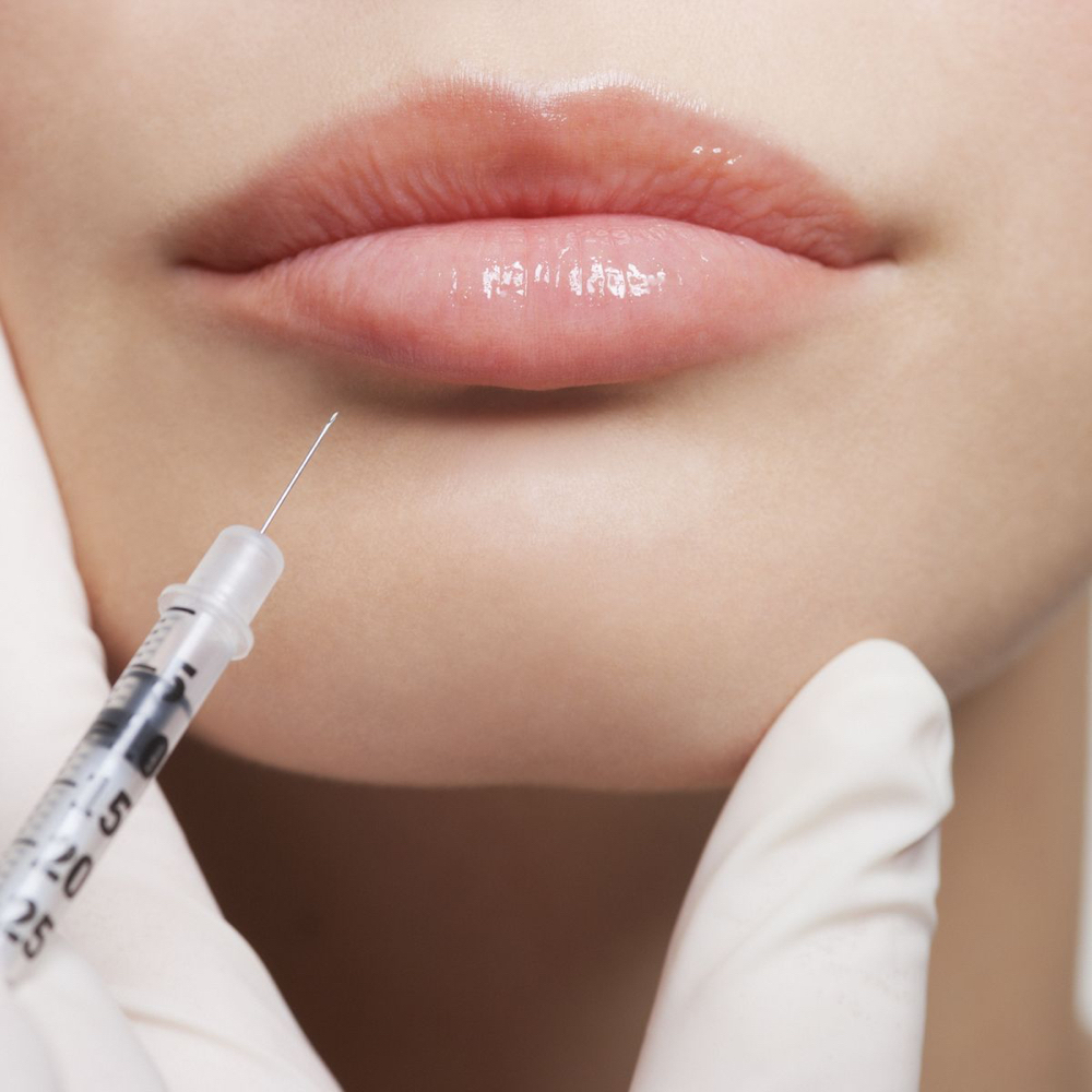 Lip Filler 1mL at Savy Aesthetics in San Antonio, TX