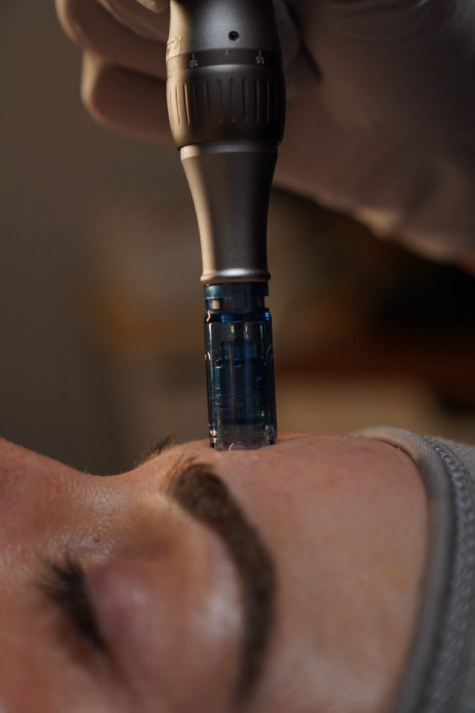 Microchanneling Facial