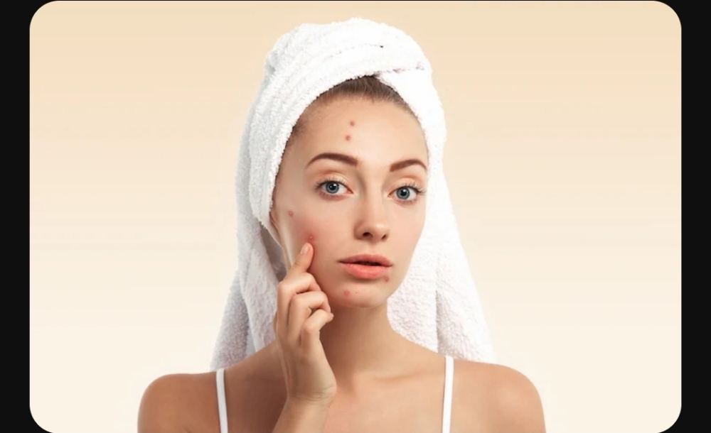 Spa Facial- Acne Facials
