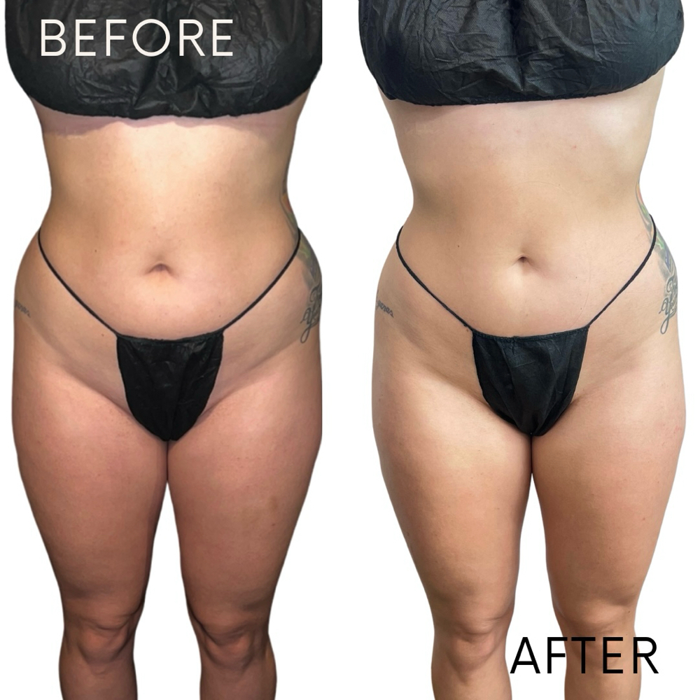 SIGNATURE 360 SCULPT(Back included) at House Of Dolls Aesthetics And Body Sculpting in Richardson, TX