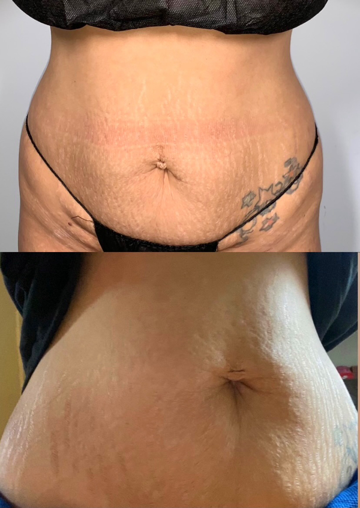 Express Body Tightening ONLY