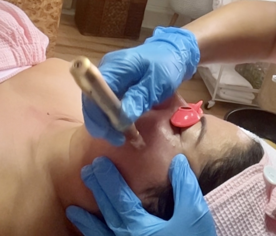 Microneedling & Hyaluronic Acid