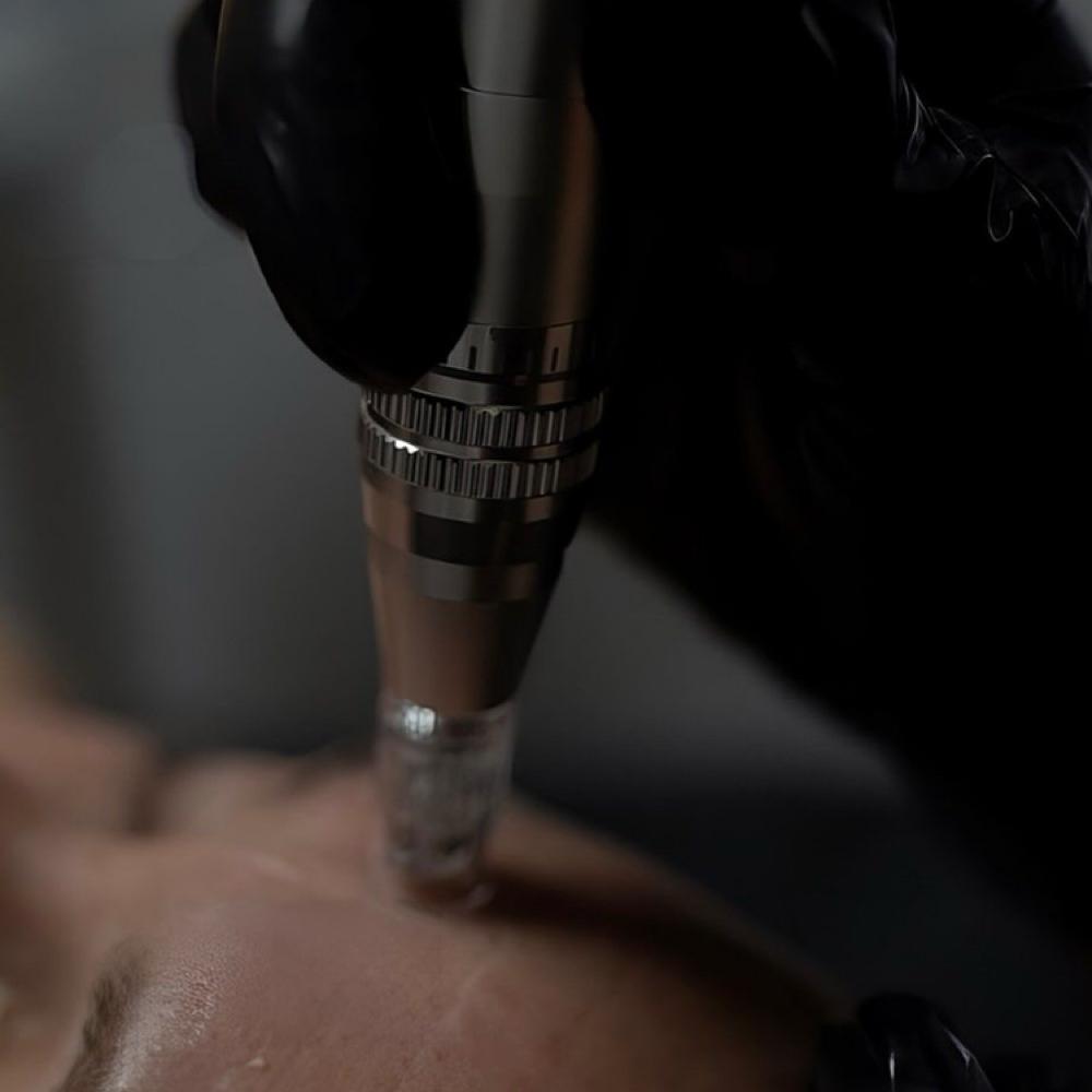 Micro channeling at Accentuated Beauty in Corpus Christi, TX
