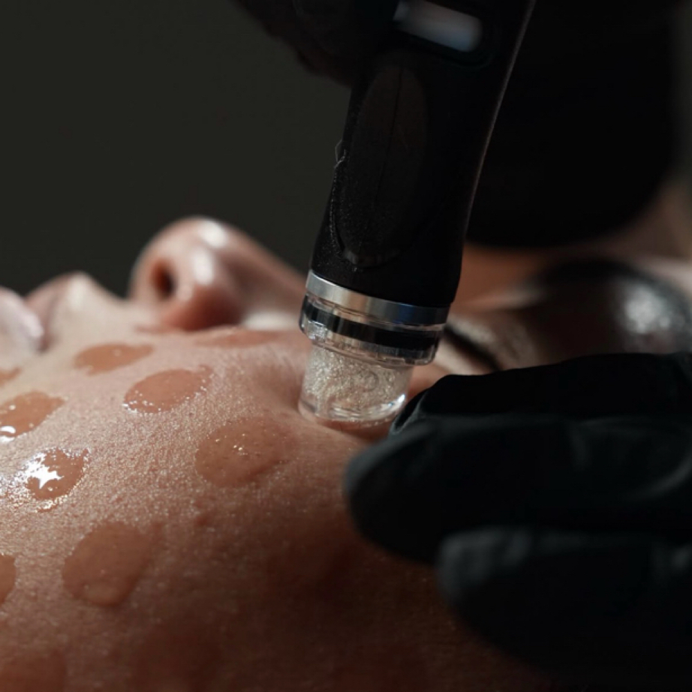 Hydrodermabrasion Facial at Wanderlust Aesthetics By Emily in Longview, TX