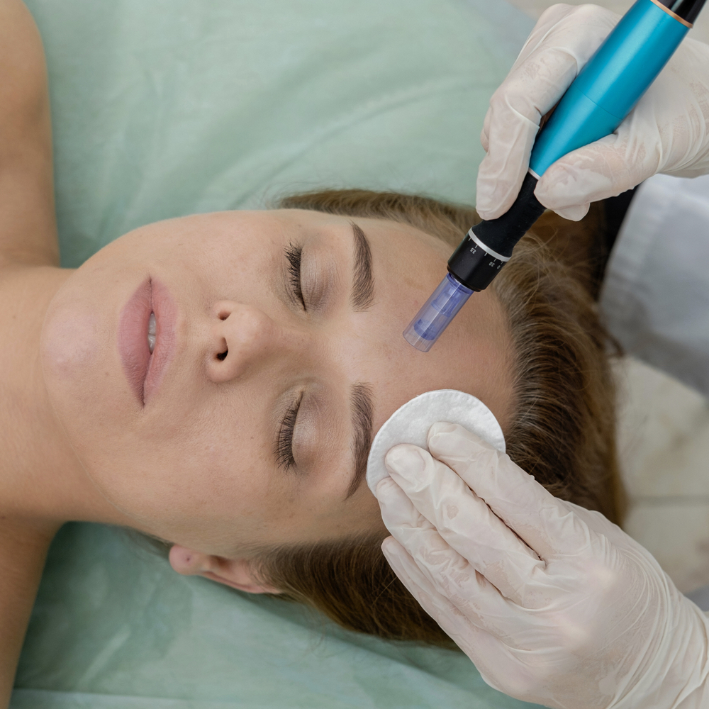 Microneedling with Exosomes at Cherlyn Deleonabreu “Perfectly You” in Liverpool, NY