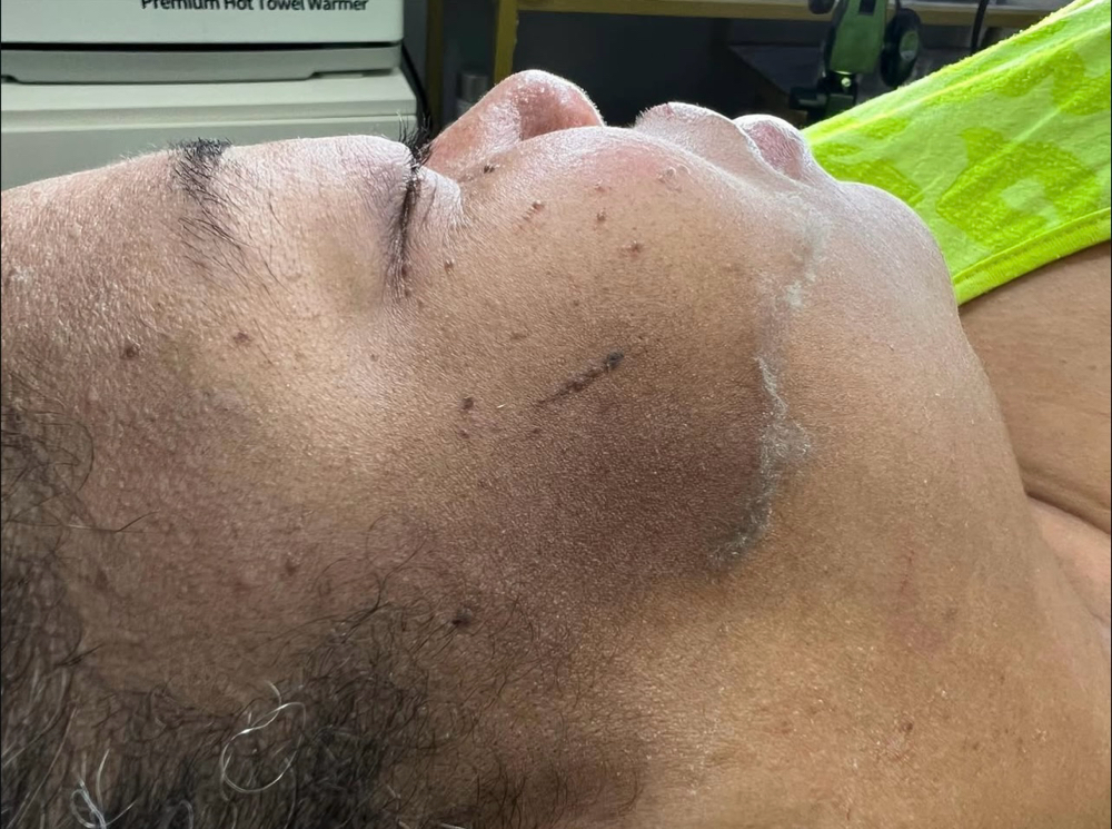Dermaplane Facial