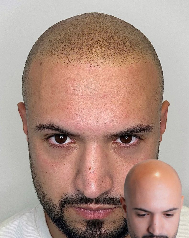 Micropigmentacion capilar