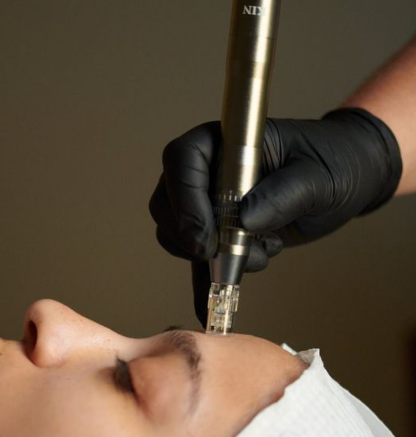 Microneedling