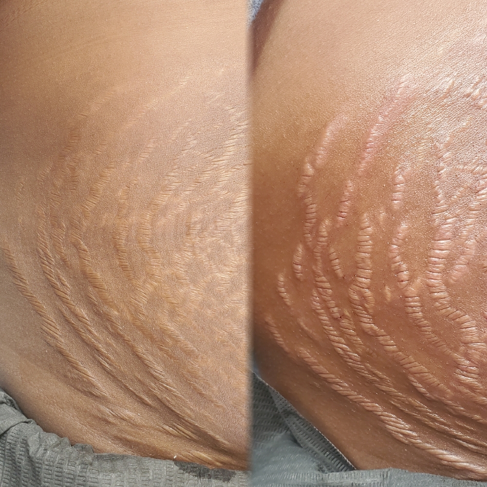 Inkless Stretch Mark Revision (ISR)