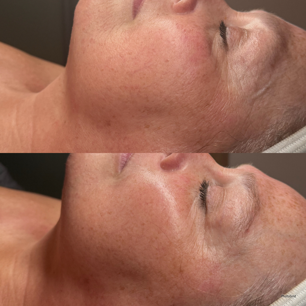 Luxe Lift Facial at Golden Moon Esthetics, LLC in Frisco, TX