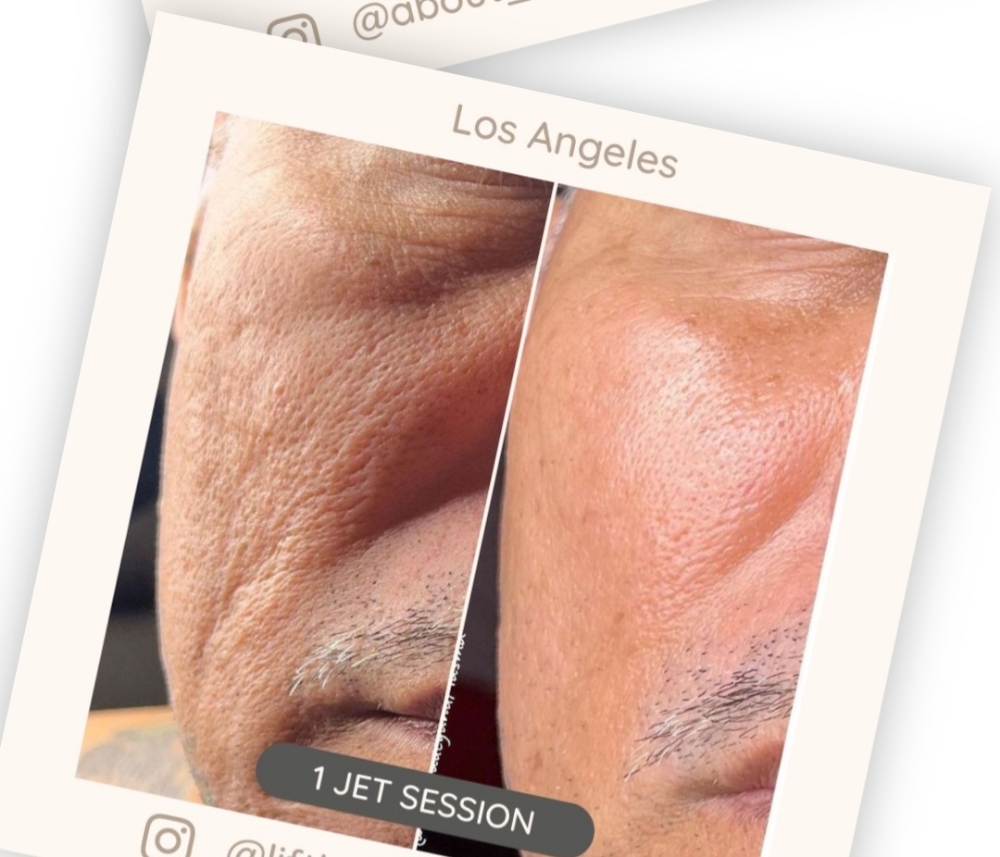 Pro PLASMA 1 Treatment