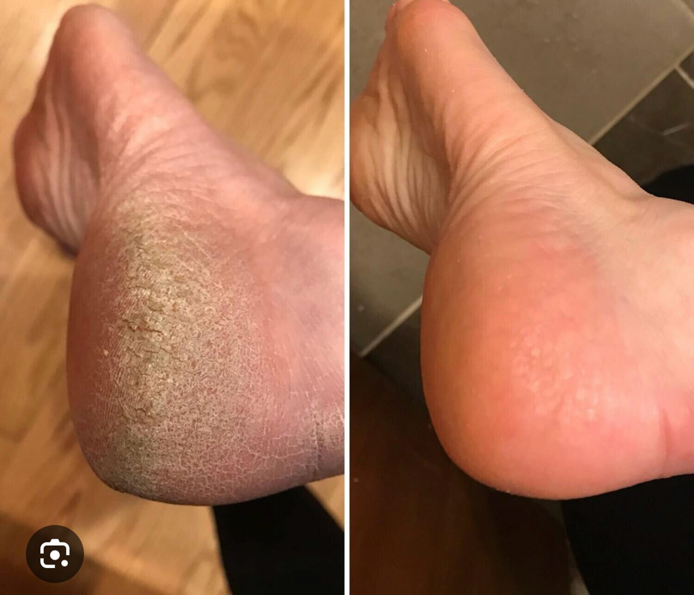 Luxury Callus Removal Pedi