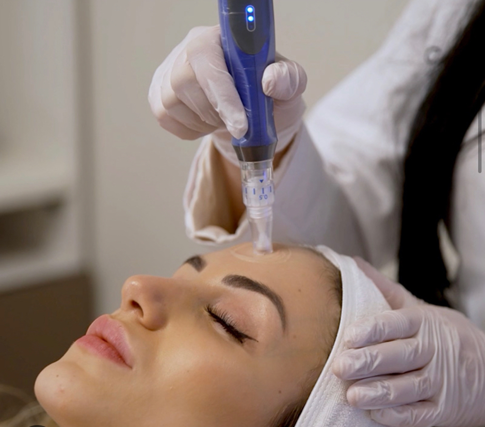 Microneedling