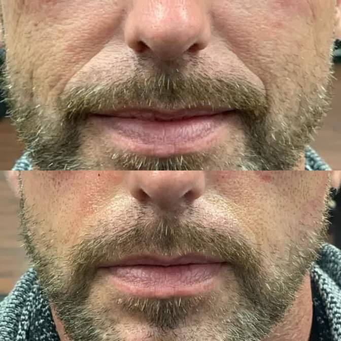 Med Fibroblast Treatment 3 Spots