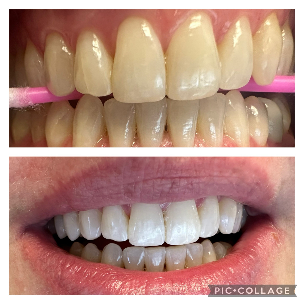 90 Minute Teeth Whitening