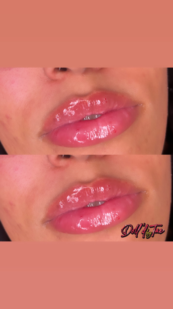 Needle-less Lip Filler Sale