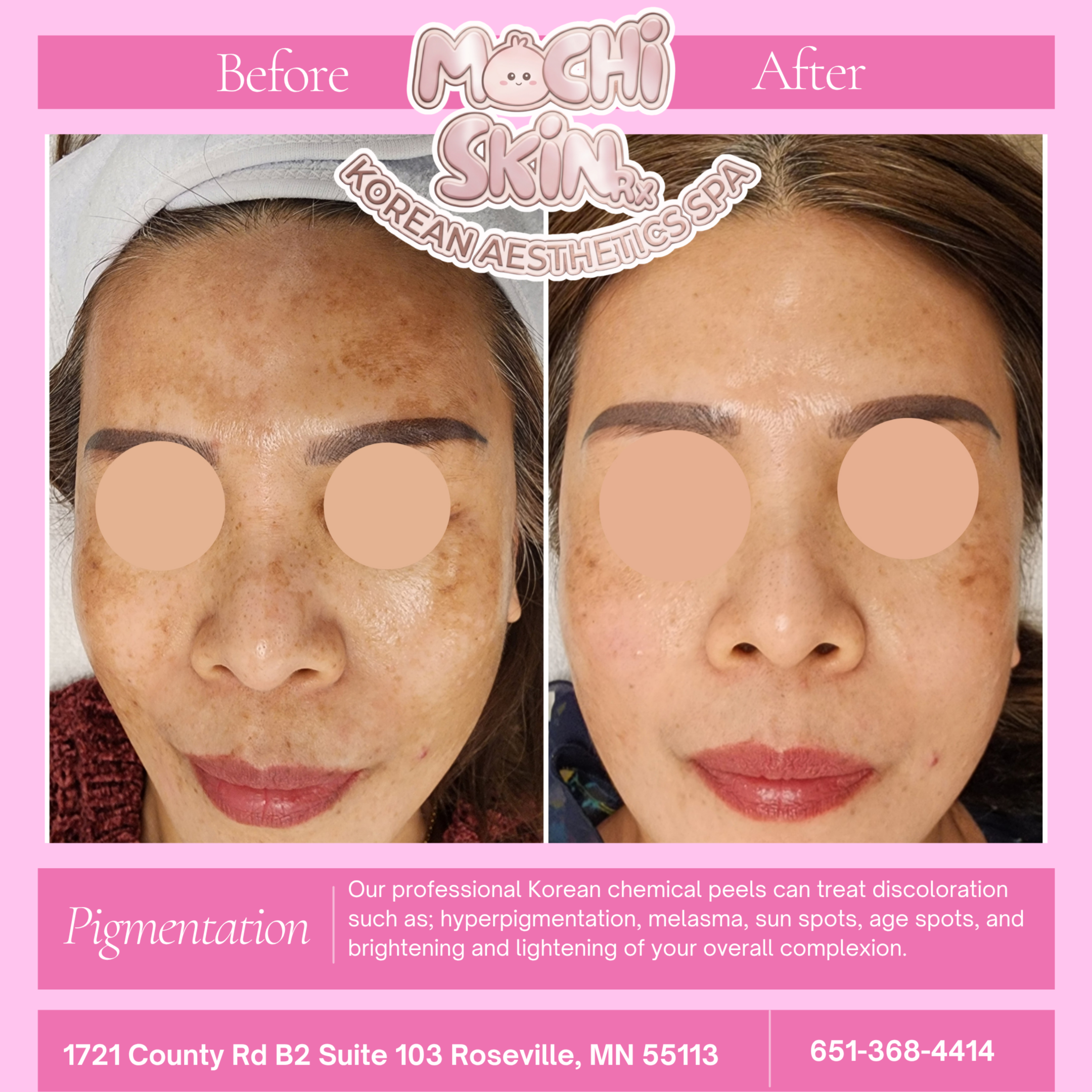 Pigmentation Treatment (Bundle) at Mochi Skin Rx in Roseville, MN
