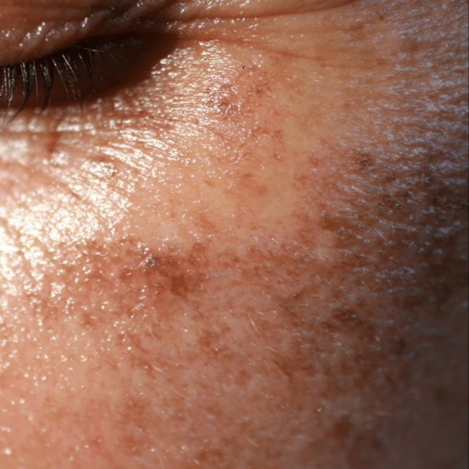 The Pigmentation Reset | Peel at Honeyveil Esthetics in Columbus, IN