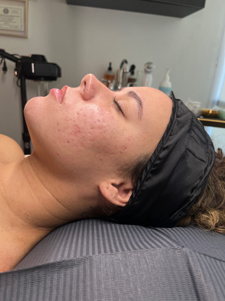 Vanishing Acne Scars Artistry