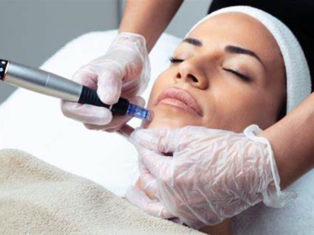 Microneedling