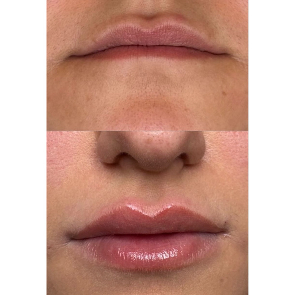 FRIDAY ONLY LIP FULL SYRINGE at Glowtox Haus in San Antonio, TX