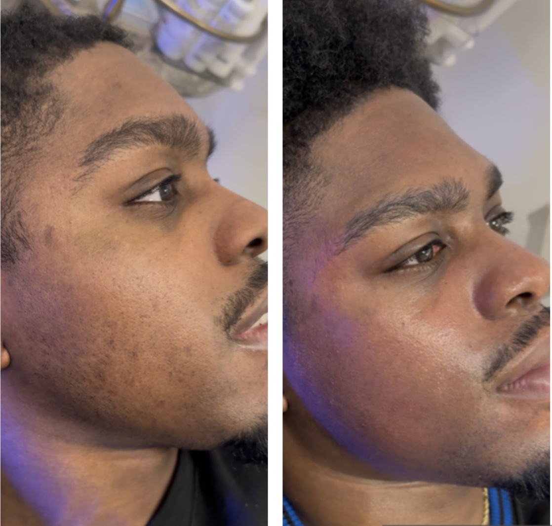 Intense Depigmentation Peel