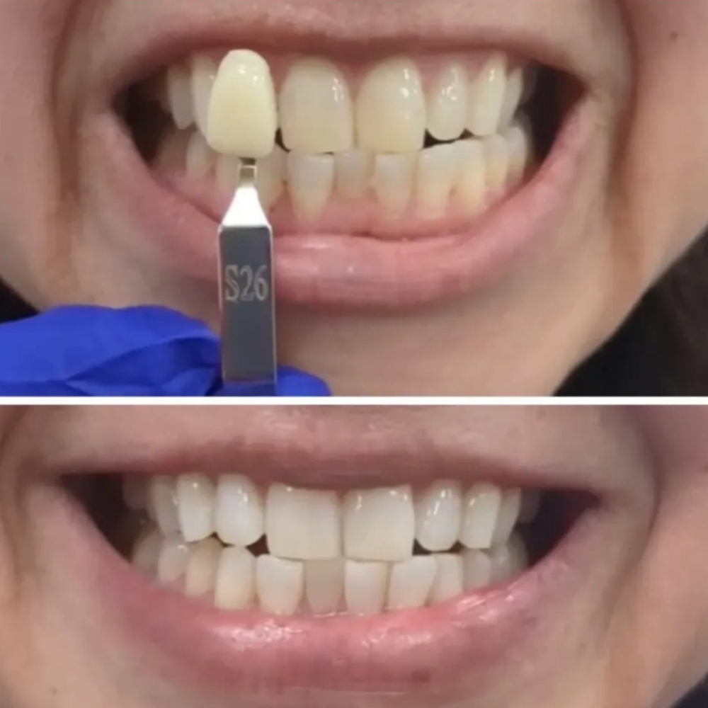 Teeth Whitening at Essentials by Rose in El Paso, TX