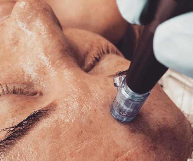 Microneedling Renewal Series at Bloom Beauty Esthetics in Salt Lake City, UT