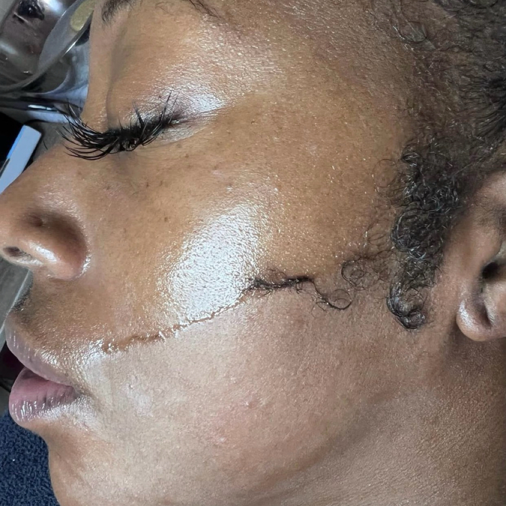 Dermaplane Facial at Radiance Skin in Pensacola, FL