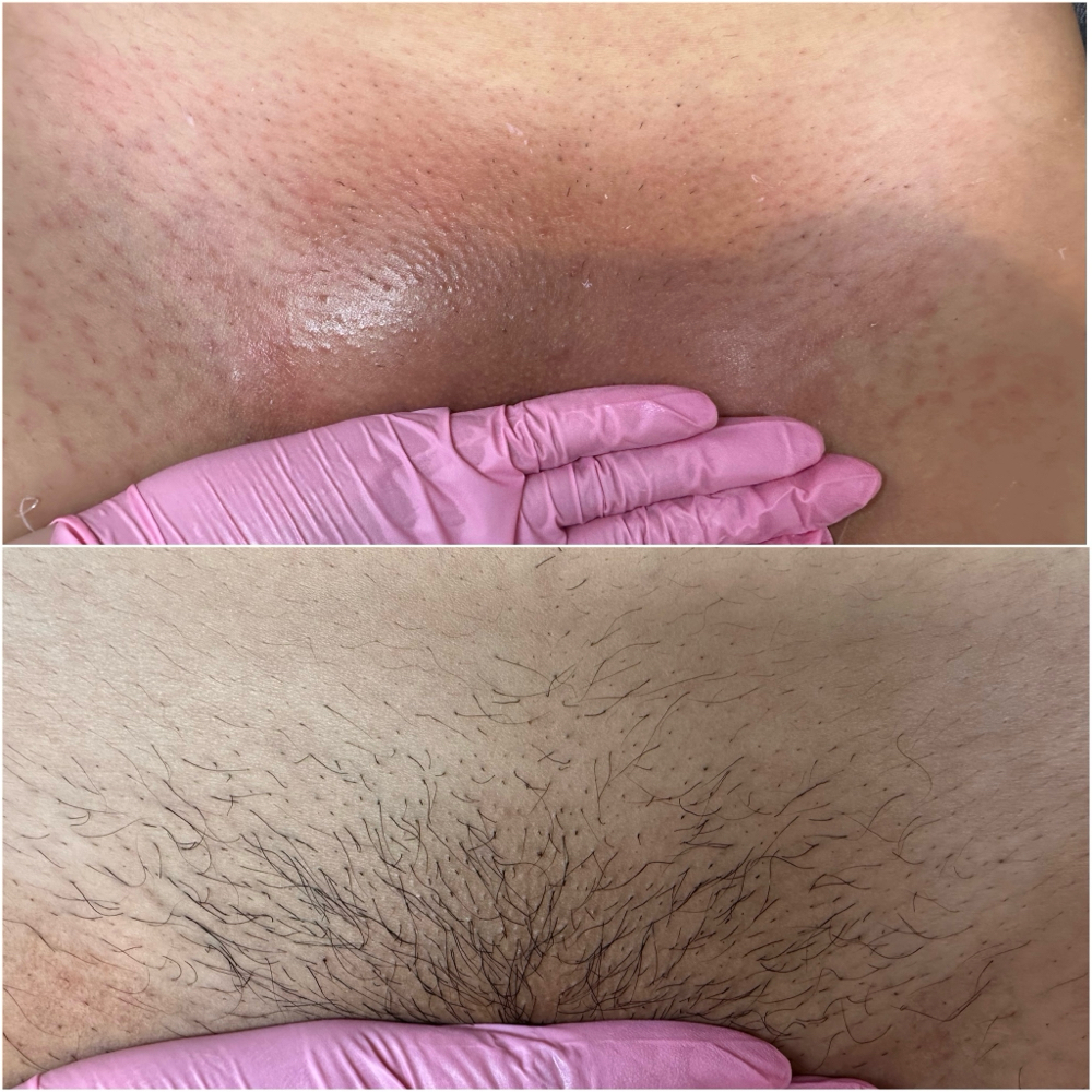 Brazilian Wax (Female Anatomy)