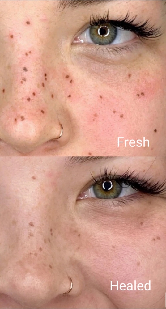 Freckle Tattoos: Complementary TU at JULES COSMETIC ARTISTRY in Omaha, NE