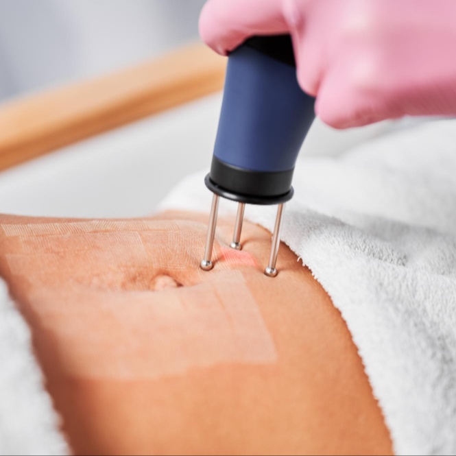 Scar Removal - Large incisions at Finer Beauty Spa in Bronx, NY