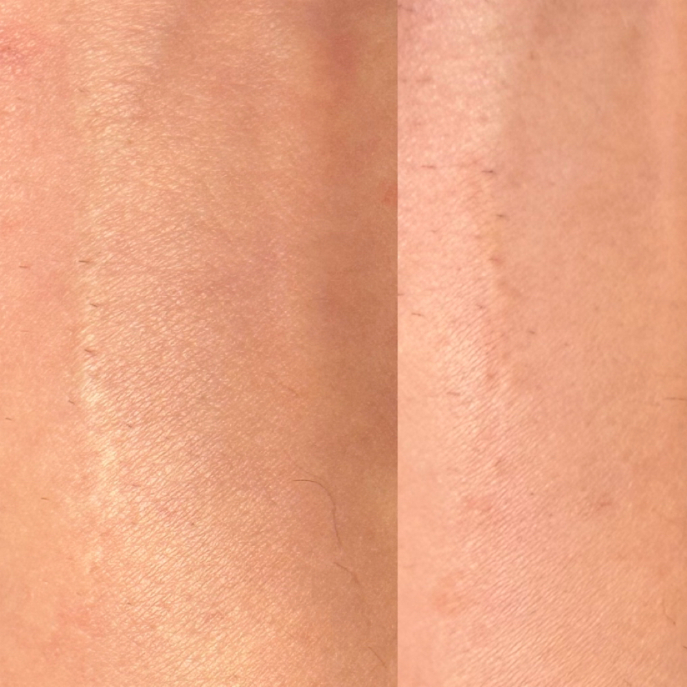 Scar / Areola Camouflage Consult at Ink Theory Aesthetics in New Braunfels, TX