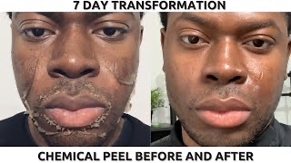 Chemical Peel at The Diamanté Effect in Valley Stream, NY