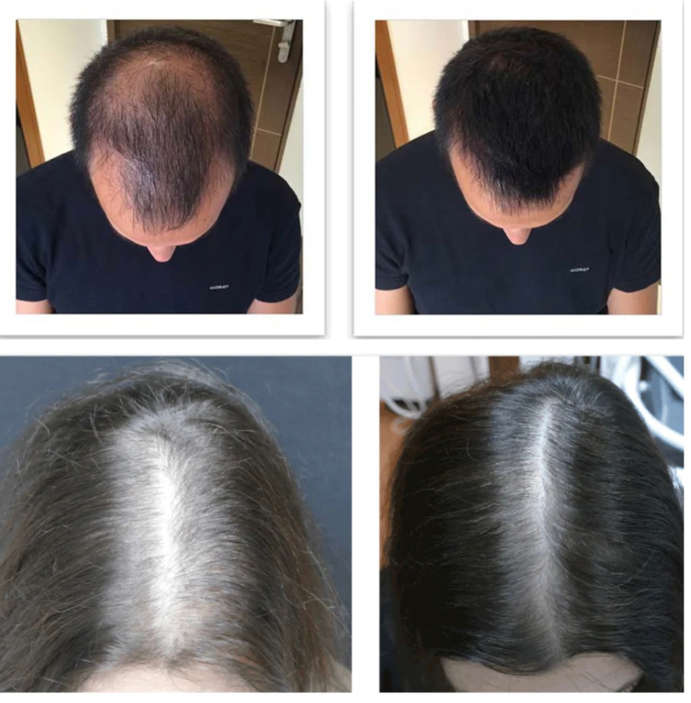 Scalp Rejuv Treatment