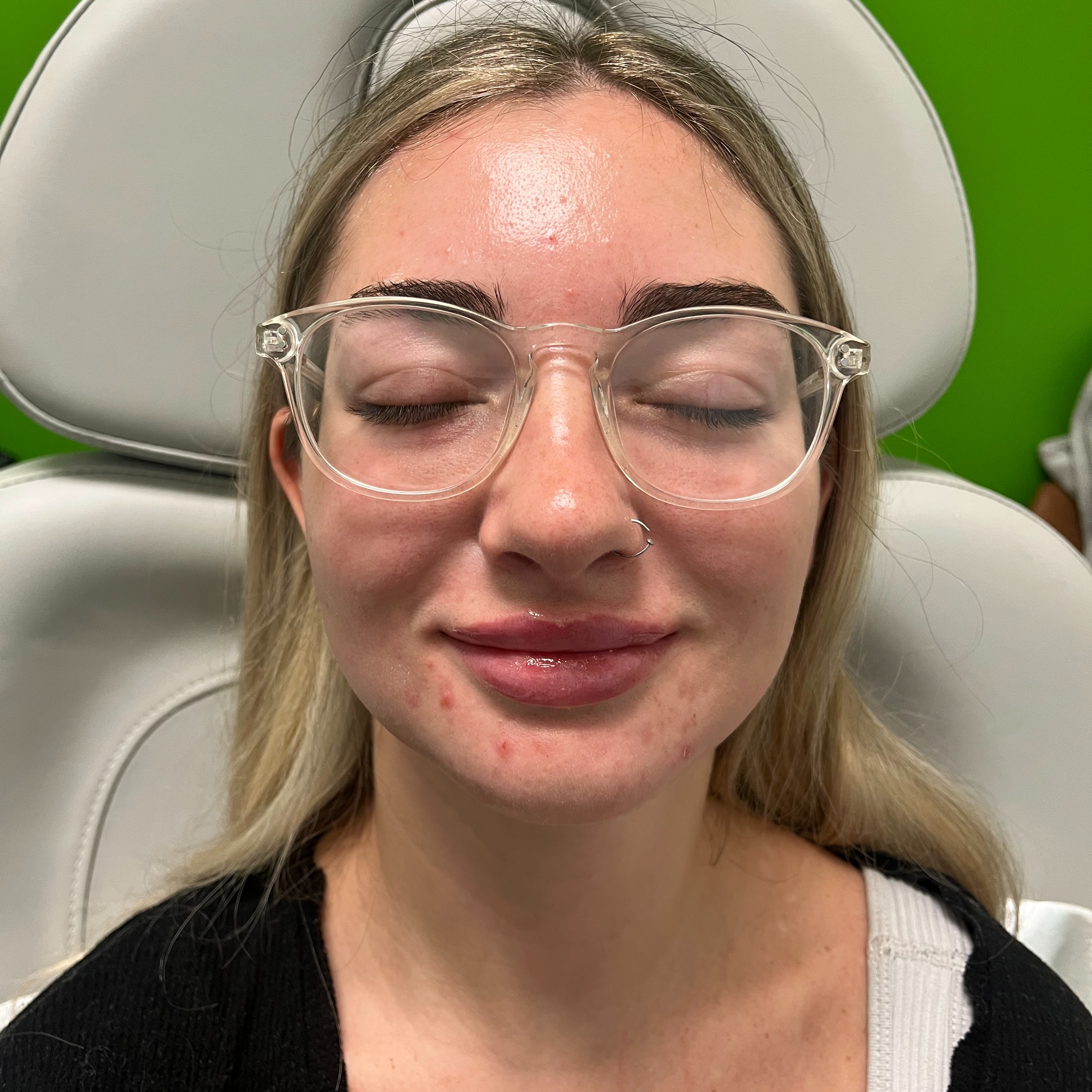 Filler - Half Syringe at Genesis Health and Beauty Bar in Daphne, AL