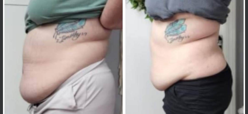 4d Lipo & Skin Tightening 1 Spot