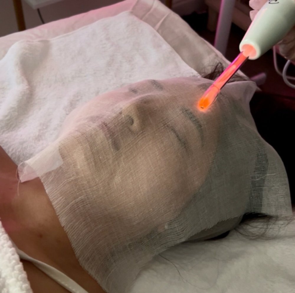 Microdermabrasion Facial