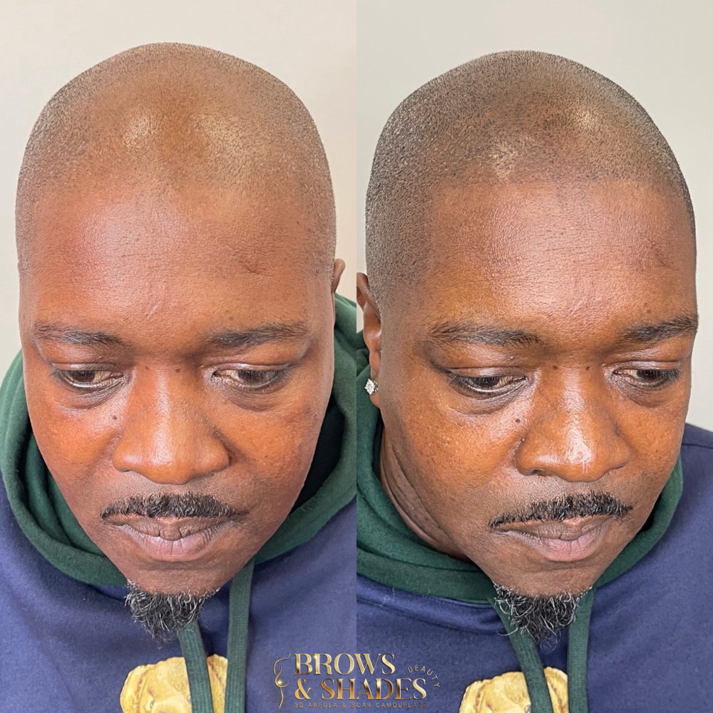 SMP (Scalp Micropigmentation)