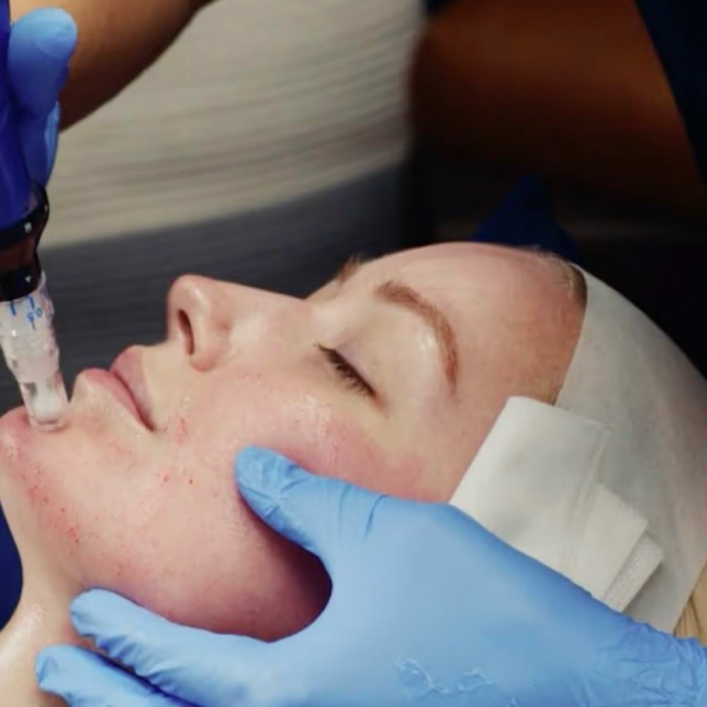 SkinPen Microneedling at Vanessa’s Skin Studio in Wilmington, NC