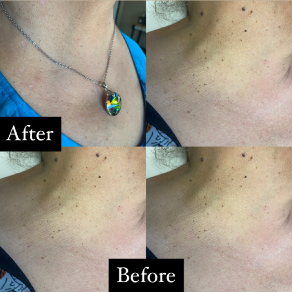 Lamprobe Skin Tag Removal at Hidden Jen Esthetics in San Marcos, TX