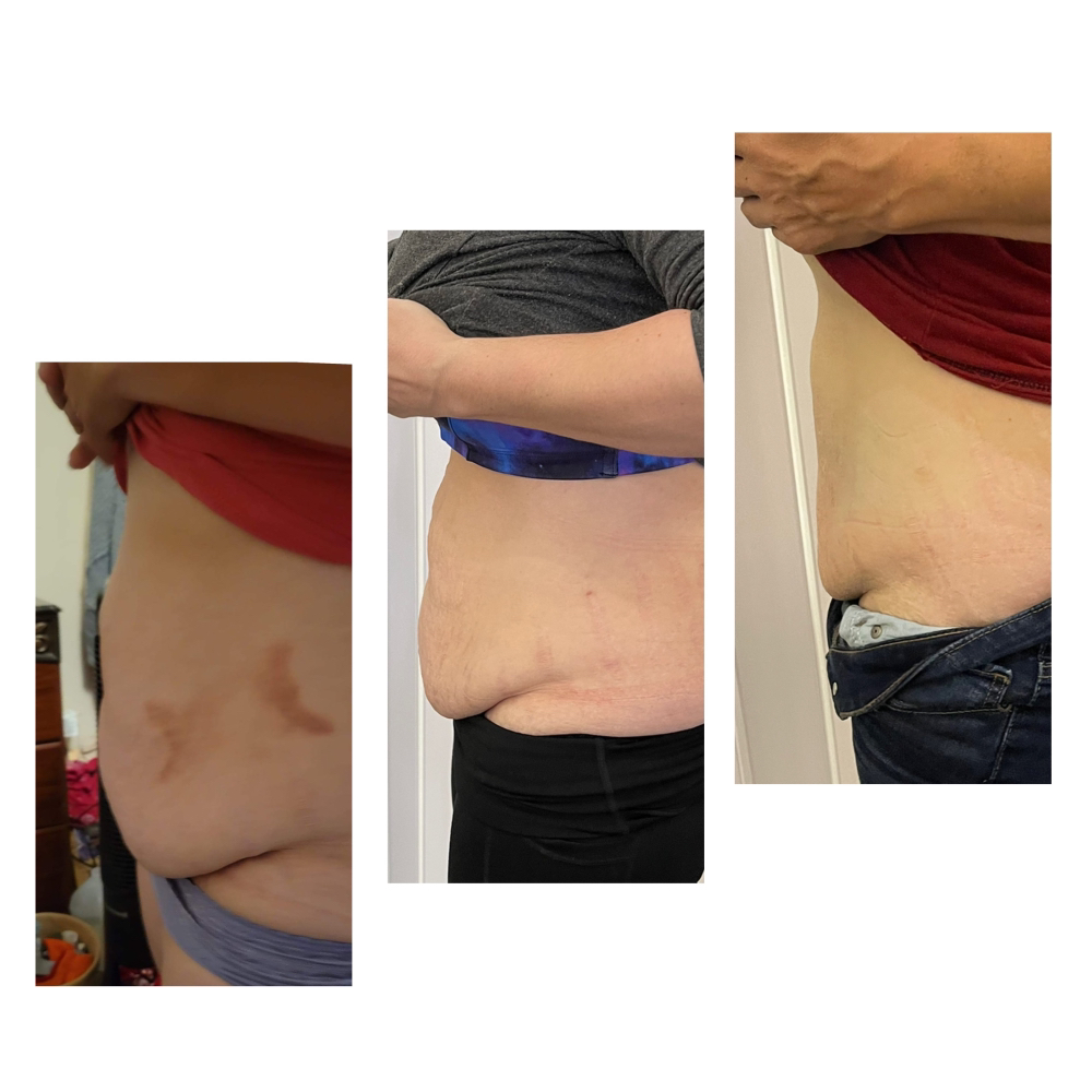 Fat Freezing