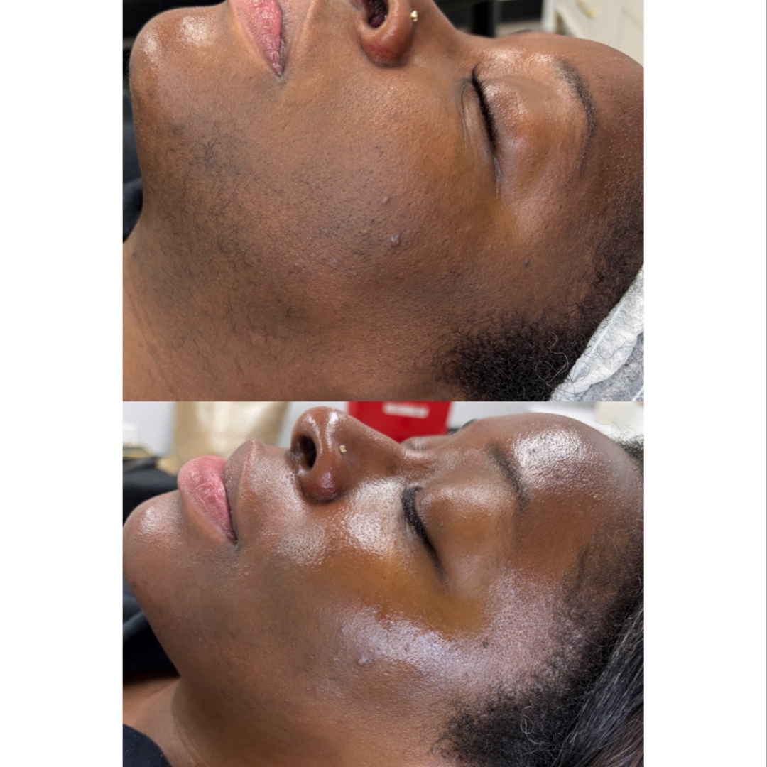 DermaFusion FACIAL at FIRMÉ SKIN in Columbia, MD