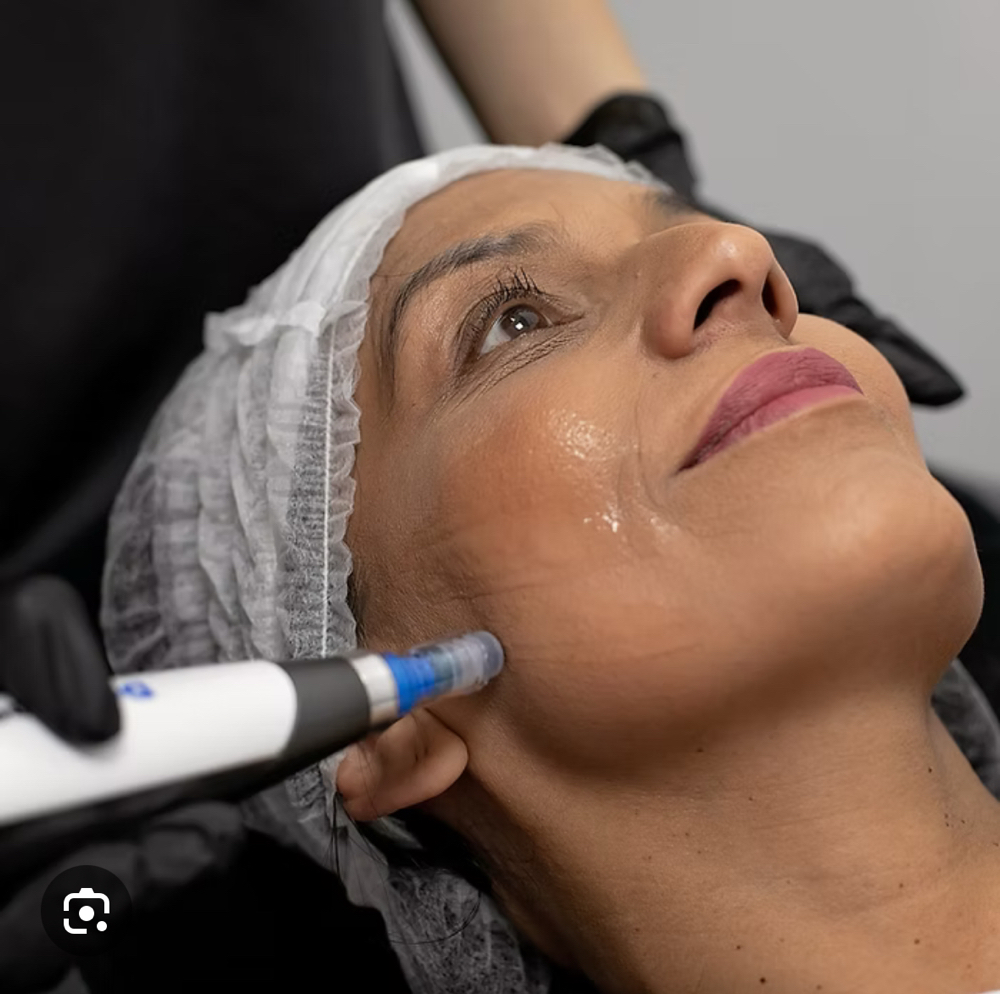 ✨ Microneedling Facial