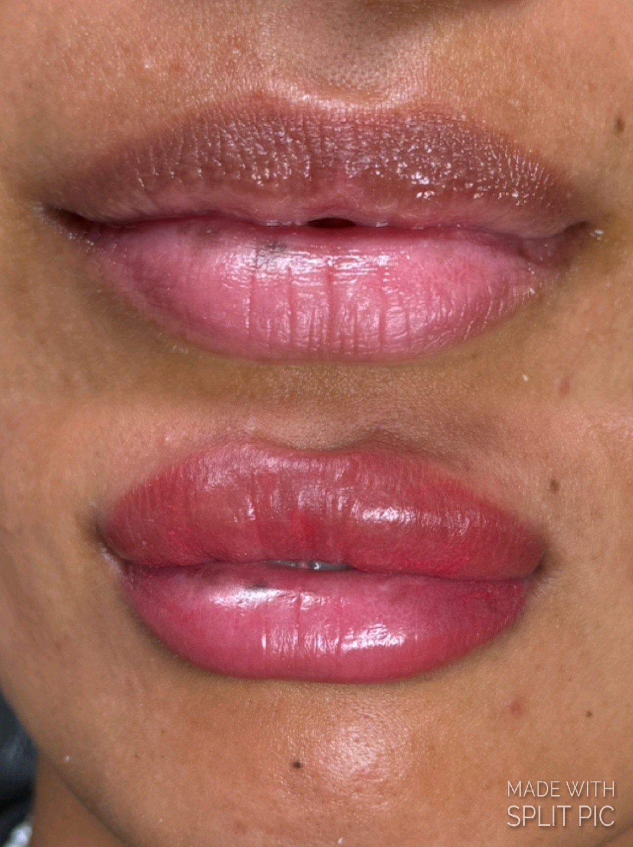 Lip Neutralization at Sapphire in Greensboro, NC